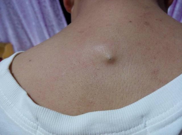 后背螨虫的症状和治疗方法,螨虫爬过皮肤的症状