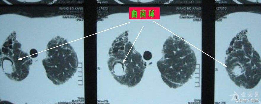 肺癌诊断恶性会有咳血可能吗,肺癌早期咳血治不好严重吗