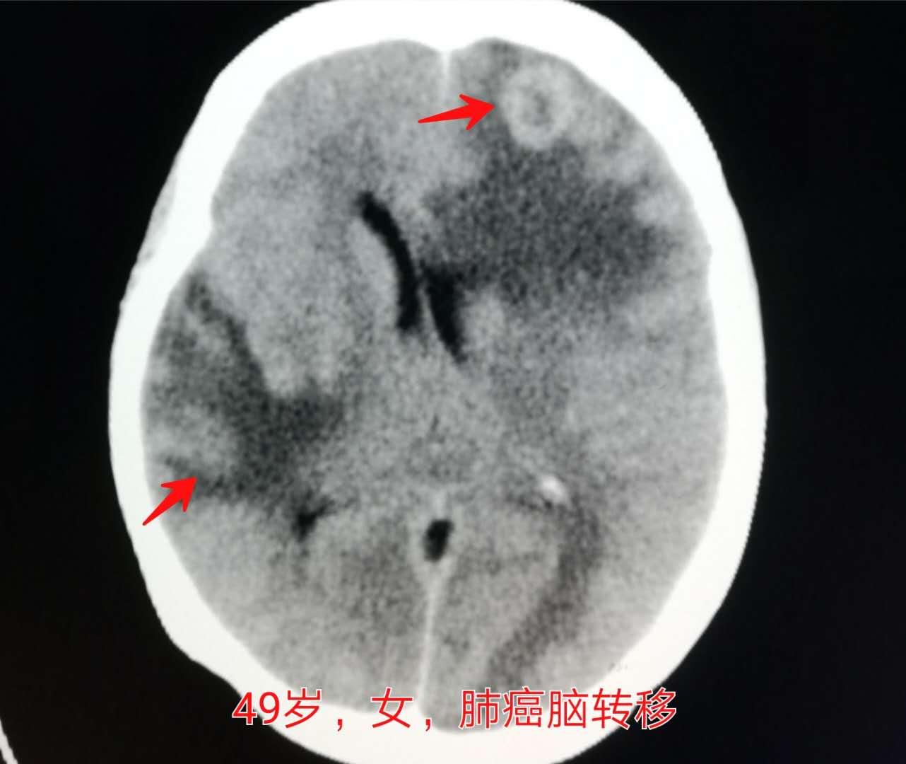 4种症状要查脑血管,这些症状一定要做脑血管造影