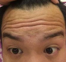 抬头纹特别深是怎么回事,有抬头纹太严重是什么原因导致的
