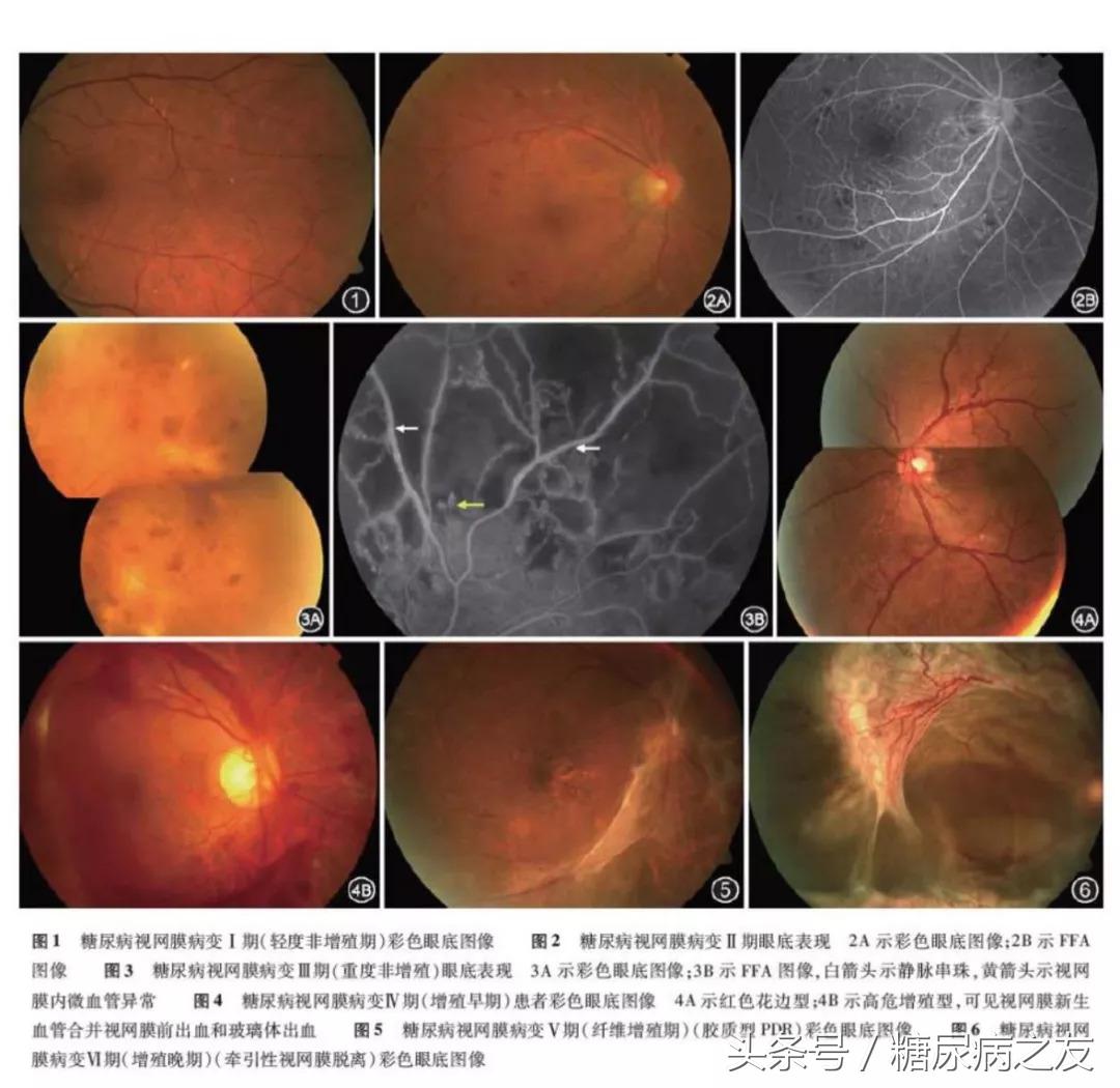 9个问题让你彻底读懂：糖尿病眼底病变做激光治疗是怎么回事