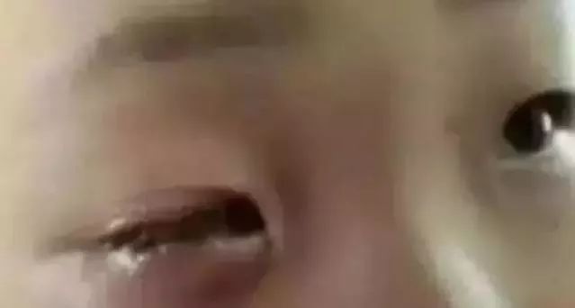 孩子眼球20分钟被熔化,6岁孩子眼球10分钟被融化