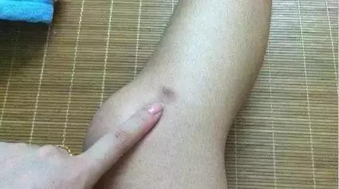 为什么你的身上会无缘无故出现淤青?这4种情况最要命