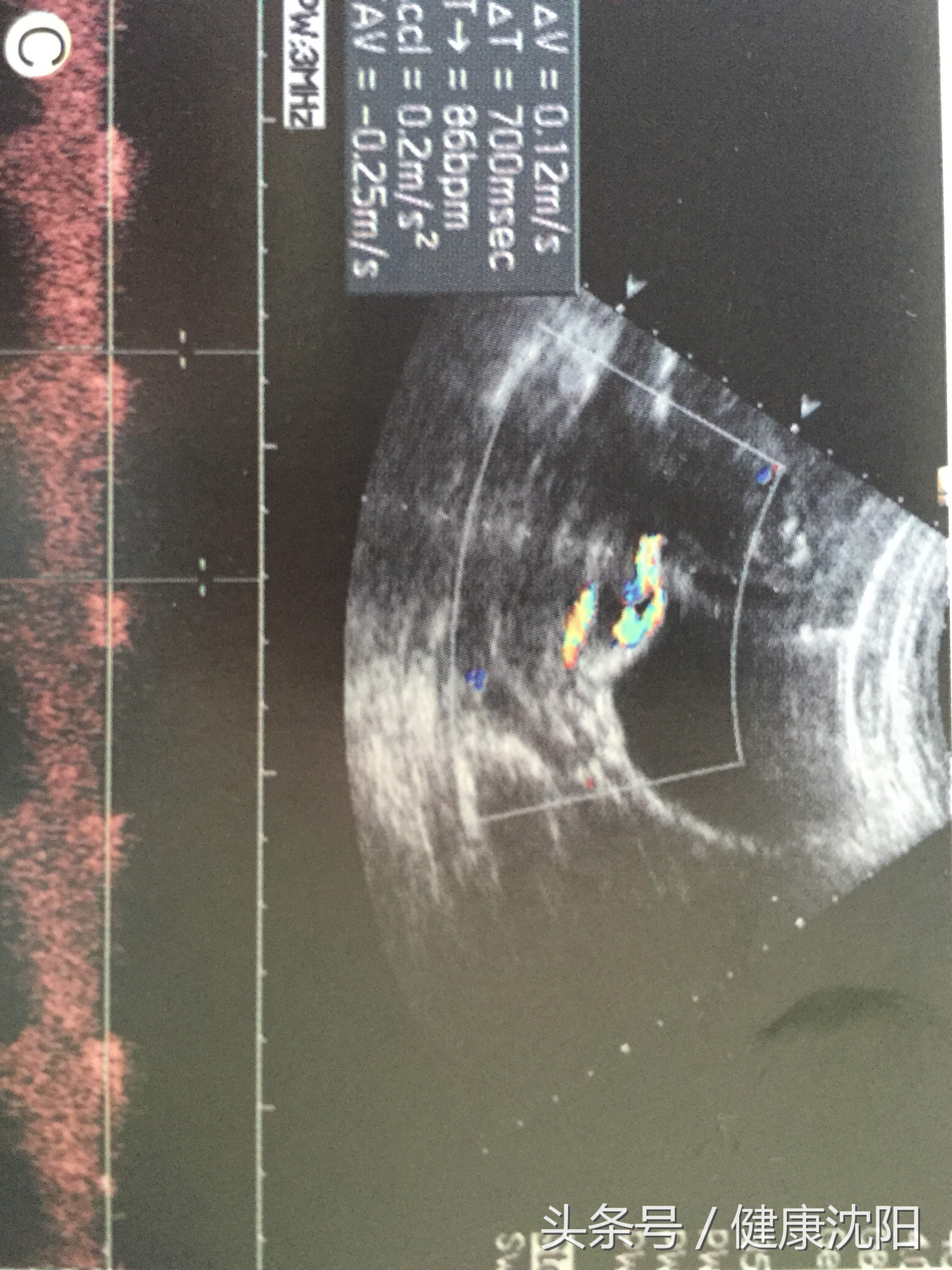 胎儿血管前置如何预防,孕妈课堂新生儿疾病筛查解读