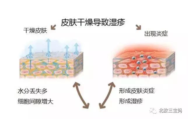 怎么分辨宝宝热疹湿疹荨麻疹,幼儿急疹和湿疹风疹有什么区别
