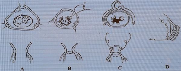 「CSCQICC2018」胡盛寿：心力衰竭的外科治疗