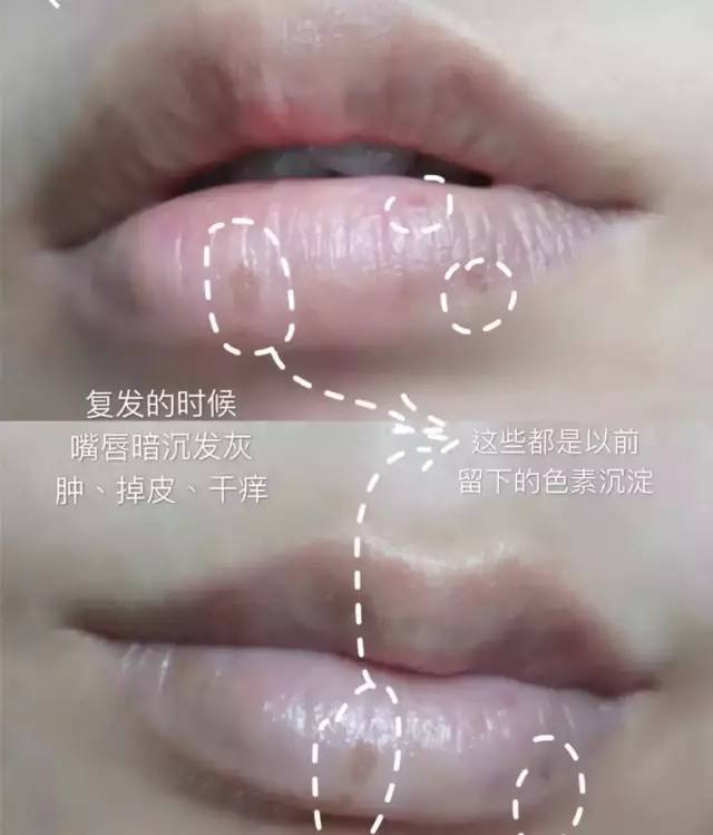 秋冬嘴角干燥、脱皮、发炎？涂点这个，立刻还你幼嫩双唇，让人想要一亲芳泽！