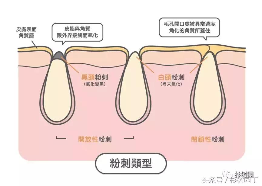 哪种维生素b6能治痘痘,网上说维生素b6能止痒