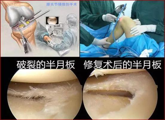 半月板受过伤的球友训练常见误区,半月板损伤常见的二十个问题