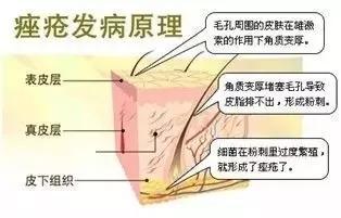 脸上痘痘贴什么遮住,痘痘贴消炎最快方法