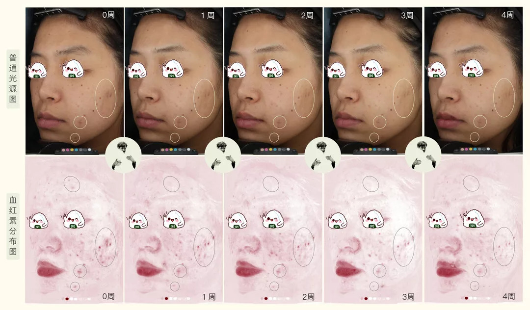 30天花80块去掉陈年老痘印到底有没有可能？