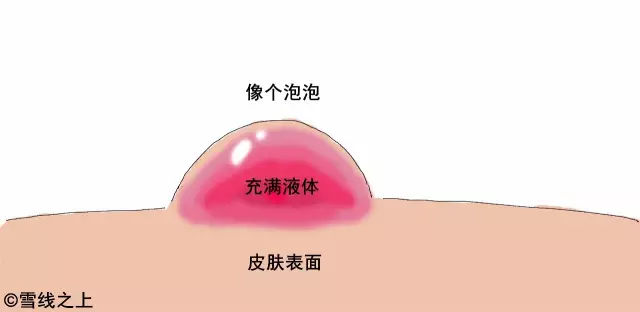 陶冶重庆｜徒步时，如何防治水泡？