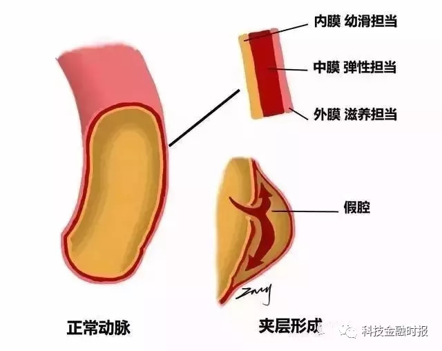 落枕跟动脉夹层,脖子僵硬麻木是颈动脉夹层吗