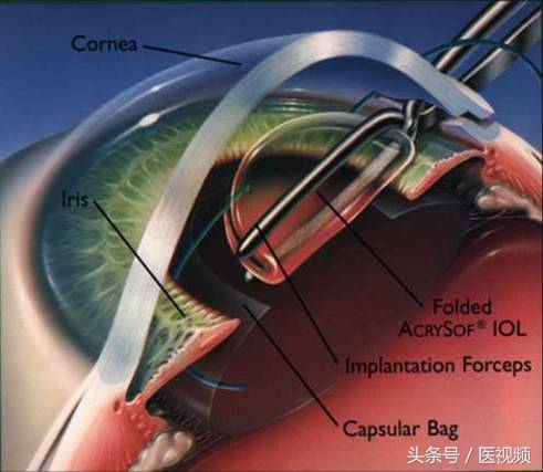 拨开层层迷雾真相就在眼前,揭秘白内障你真的了解它吗