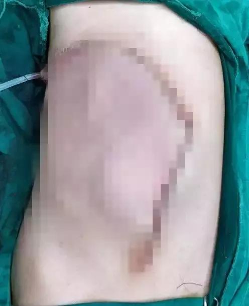 罕见!肝脏长出体外12年,被医生塞回少女身体内!