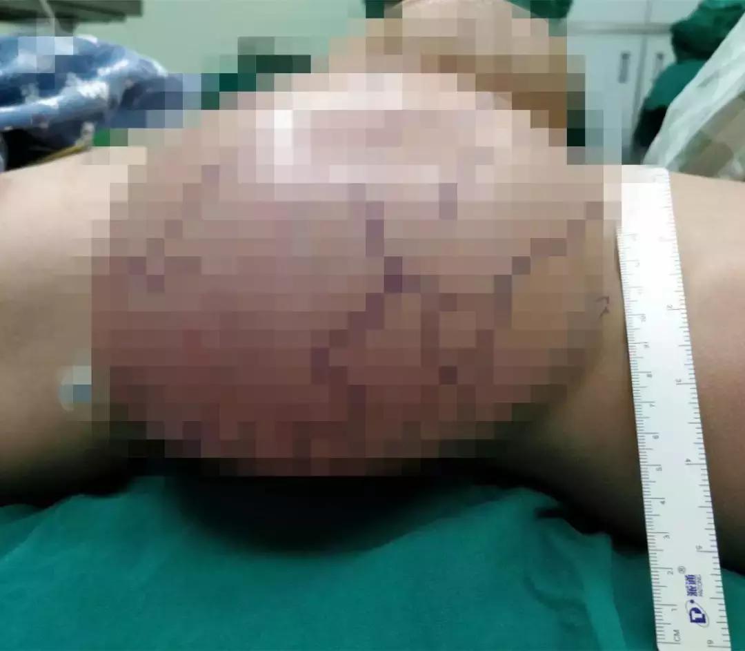 罕见!肝脏长出体外12年,被医生塞回少女身体内!