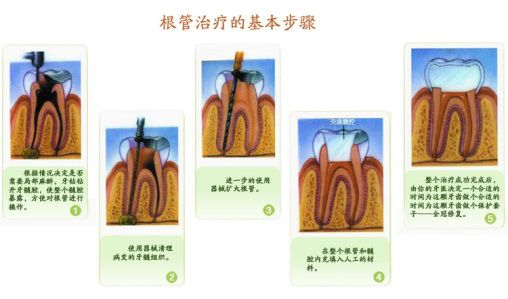 孩子蛀牙不会痛，医生为啥要杀死牙神经！你家娃中招了吗？