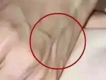 警惕肝脏的5个征兆,肝青筋