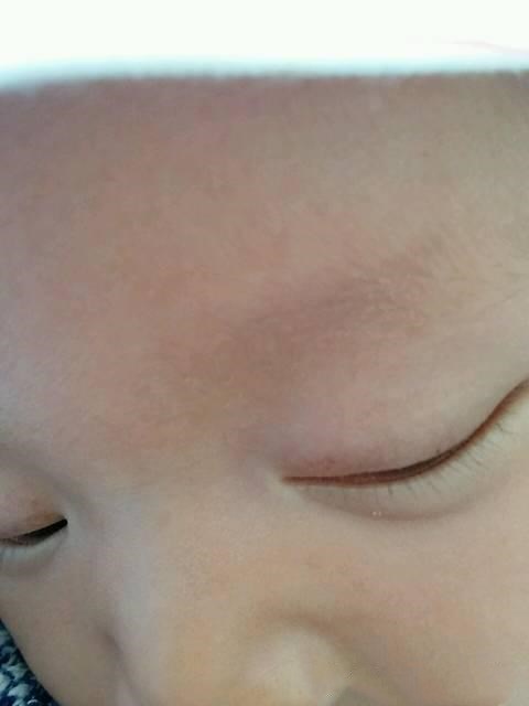 小孩感冒咳嗽眼睛有什么变化,小孩常流鼻涕咳嗽是什么原因