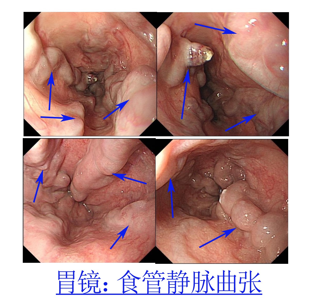 肝硬化中西医结合治疗并发症,肝硬化tips介入手术并发症