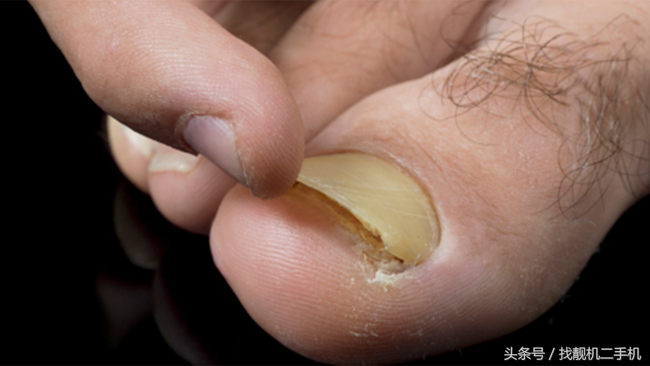 脚指甲长到肉里面，到底要怎么办？