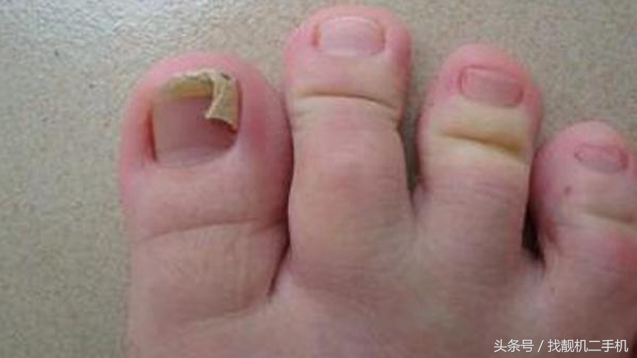 脚指甲长到肉里面，到底要怎么办？