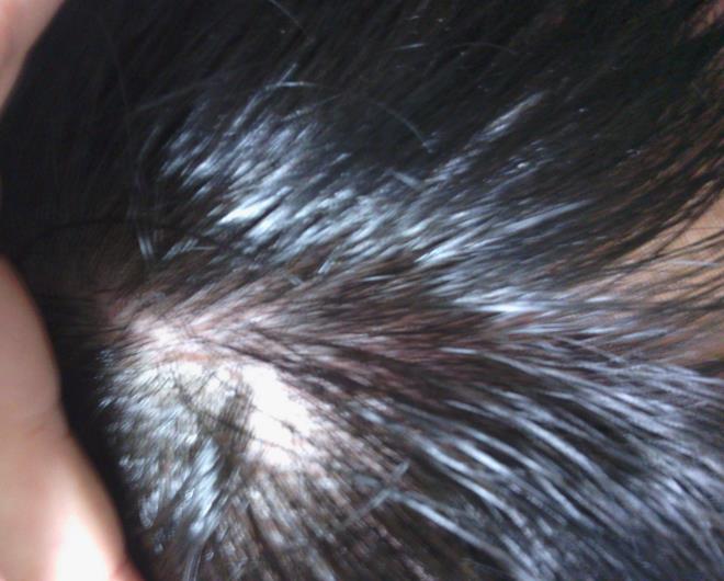 怎么除头螨虫最有效方法,头上螨虫怎么去除简单方法