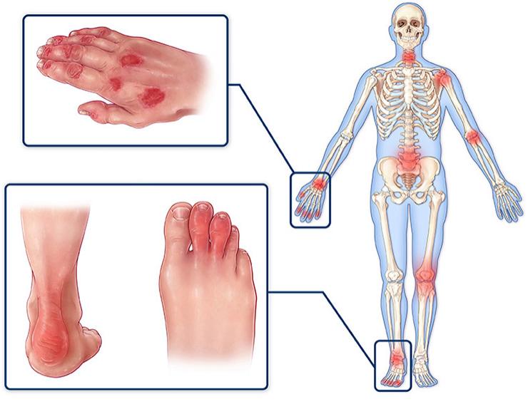 世界银屑病日银屑病关节炎,银屑病关节炎是银屑病后期吗