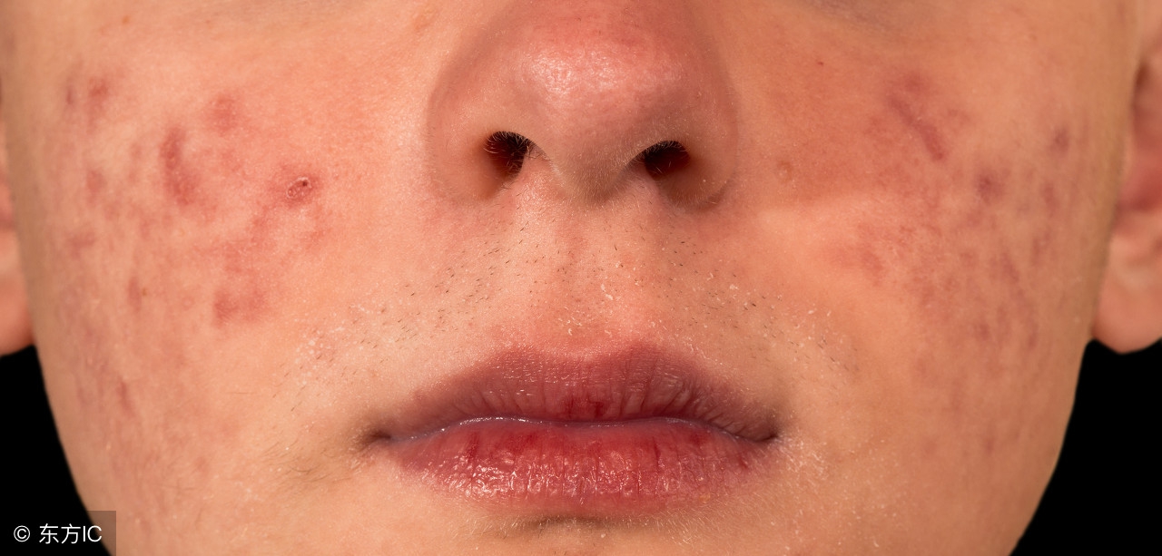 螨虫过敏儿童适合睡什么样的床垫,螨虫过敏教你一招去除螨虫