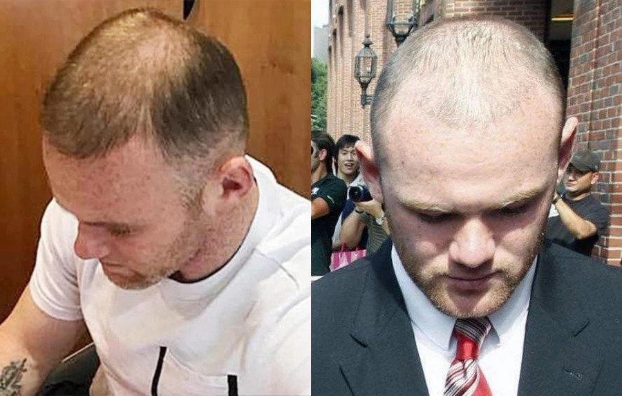 脱发严峻发际线危机,全国脱发情况