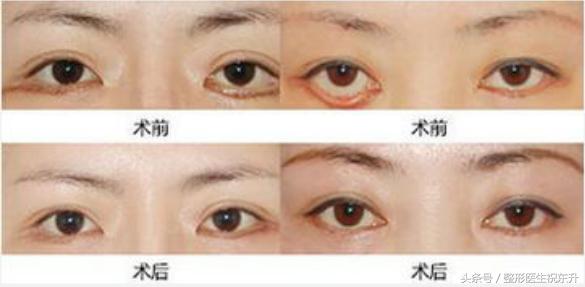 真相来了｜做去眼袋手术失败了，该怎么办？