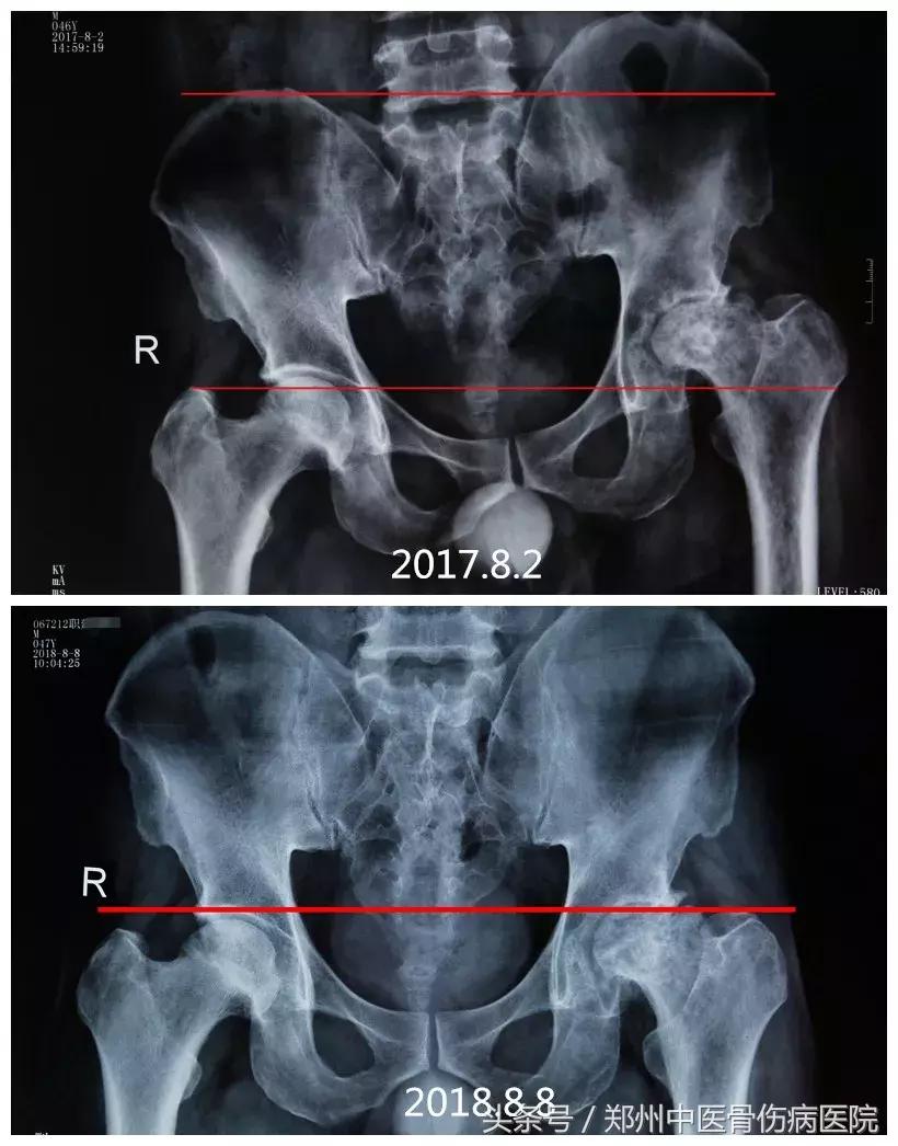 “长短腿”不是腿的问题，到底该如何娇正？答案就在这里