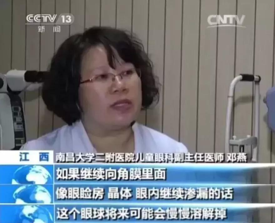 食品干燥剂遇水爆炸伤眼睛图片,误吞干燥剂眼球被溶化