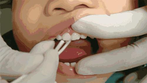 儿童牙齿龋齿怎么处理和保养,乳牙龋齿怎么办有好方法吗