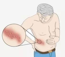 带状疱疹为什么说缠腰一圈没救了,带状疱疹绕腰一圈就好了吗