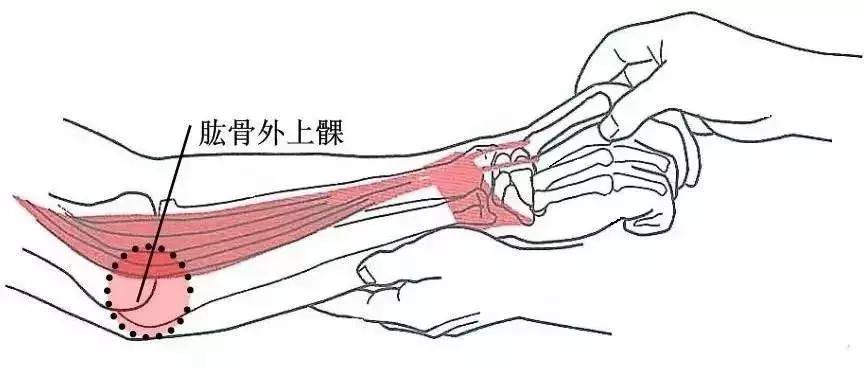 胳膊肘关节疼痛伸不直怎么办,胳膊肘内部疼痛伸不直什么原因