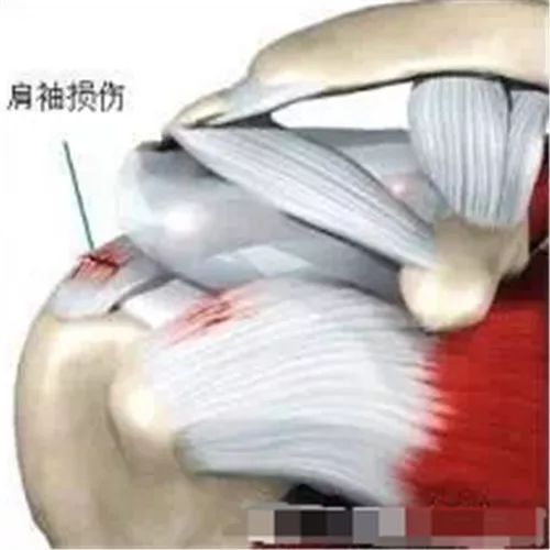 肩峰下撞击综合征影像表现,肩峰撞击综合征推拿治疗