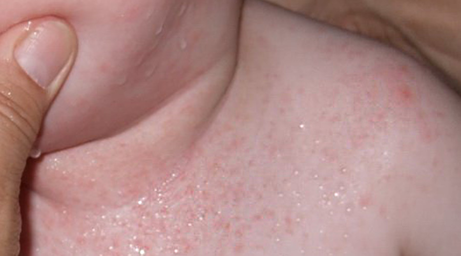 怎么分清痱子还是湿疹,怎么分清是痱子还是湿疹