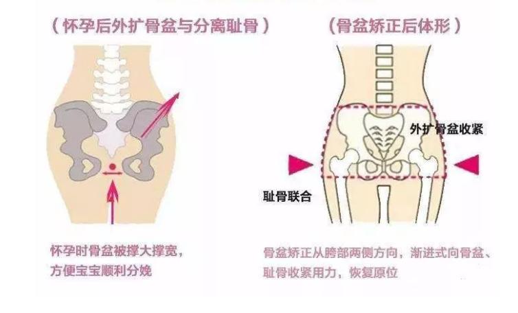 产后腰围能自动恢复吗,做了产后修复腰围少了3cm