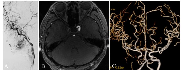 学术快报｜莫大鹏：颈动脉病变的复合手术治疗原则
