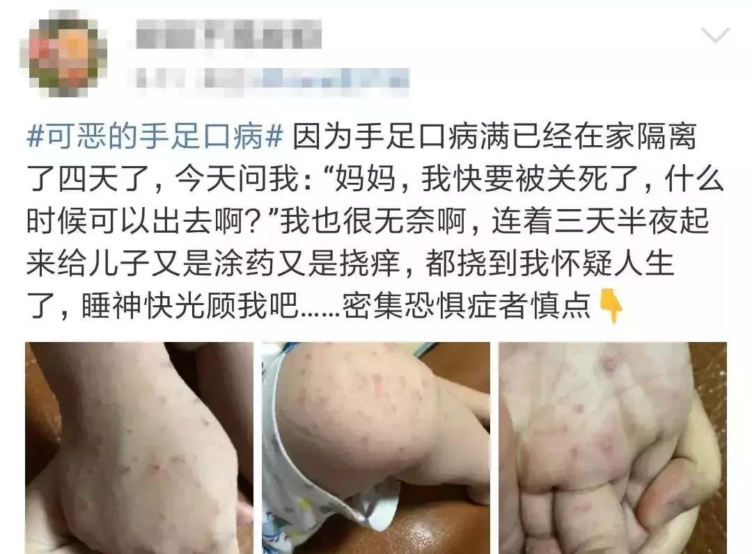 手足口疱疹性咽颊炎进入高发期,黄石手足口高发期