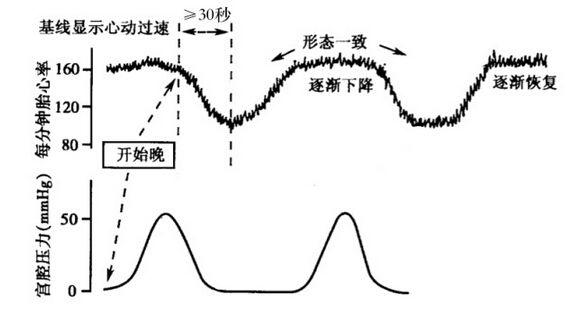 胎心监护有胎心减速是什么原因,胎心监护曲线高低变化大怎么回事
