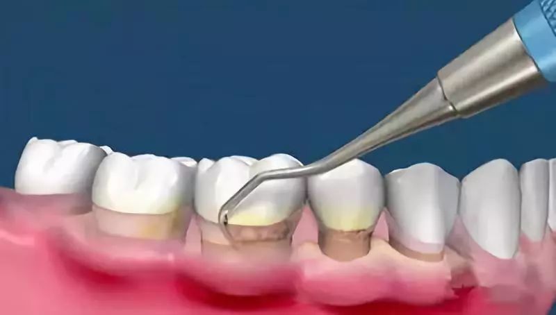 牙膏为什么能把鹌鹑蛋刷白,刷白鹌鹑蛋的牙膏