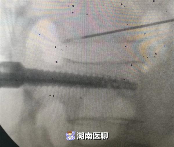 大妈摔倒路边无法动弹,70岁大妈腰直不起来