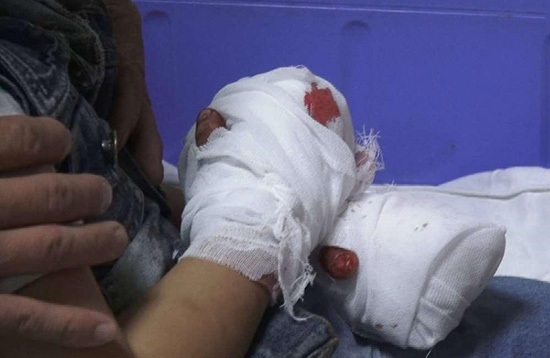 青岛5岁男孩手指被夹断,幼童手指被割断交警争分夺秒送医