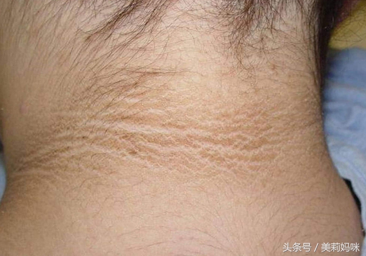 怀孕腋下变黑胸变黑脖子有黑颈纹,孕期脖子腋下发黑图片