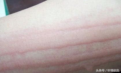 针灸艾灸结合适合的病症,针灸治疗皮肤病