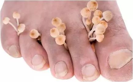 讨厌的灰指甲,还我美丽小脚丫!