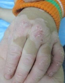 308准分子主要治疗什么,308准分子激光治疗白癜风需要多久