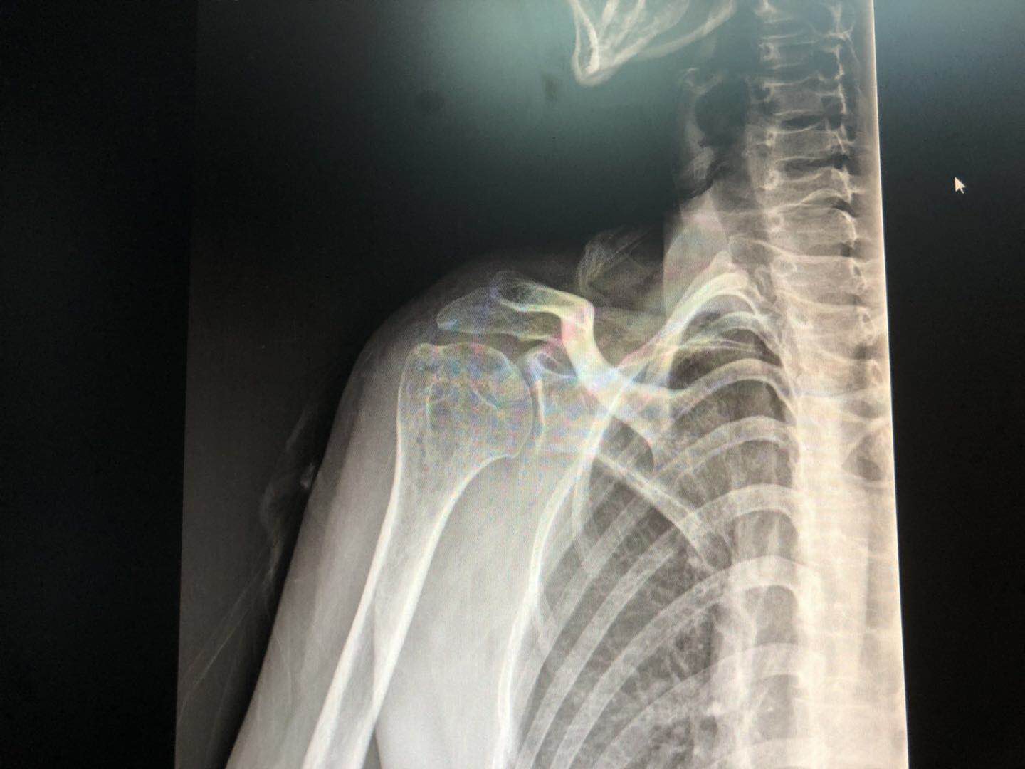 肩周炎手术松解后的锻炼方法图解,肩周炎手术治疗后怎么锻炼